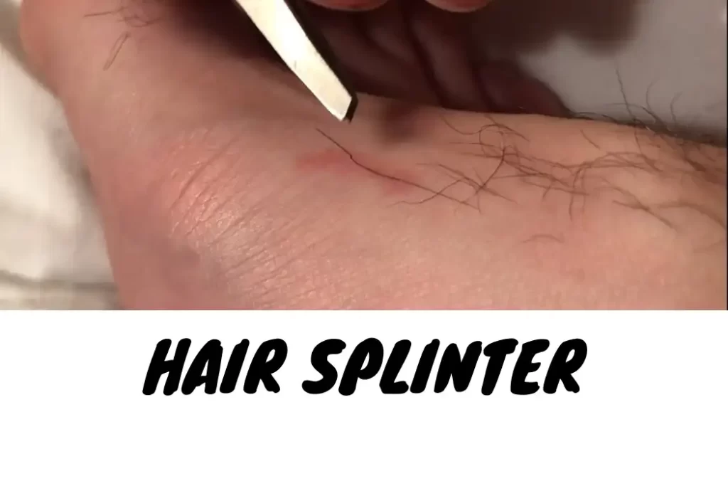 Hair Splinter 1